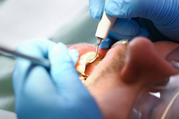 Best Emergency Dental Care for Abscessed Tooth in King City, OR