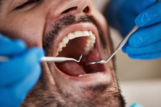 Best Emergency Dentist for Lost Fillings or Crowns in King City, OR